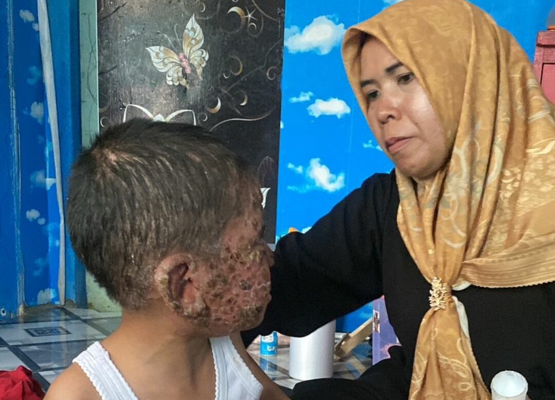 Senyum kecil Zihad Alfaritsi Eriansyah (7) tak mampu menyembunyikan derita yang ia tanggung sejak usia satu tahun.